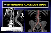 SYNDROME AORTIQUE AIGU - Les cliniques radiologiques de …onclepaul.net/wp-content/uploads/2011/07/Syndrome-aortique-aigu.pdf · excentré au site de dissection suspendue (Marfan
