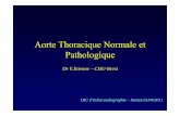 Aorte Thoracique Normale et Pathologique - … · ¾Etiologie rare de syndrome douloureux thoracique ¾Retrouvé dans 10% des DA ¾90 % des patients ont 1 HTA ... – Élargissement