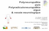 Polyneuropathie puis Polyradiculoneuropathie aigue ... · -PNP sensitivo-motrice chez un sujet énolique chronique. ... Polyradiculoneuropathie aigue inflammatoire Installation rapide