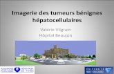 Valérie Vilgrain Hôpital Beaujon - afef.asso.fr · • Comparaison IRM de 25 HNF graisseuses en anapath et 34 autres tumeurs graisseuses • 3 formes d’HNF – Pas de graisse