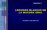LESIONES BLANCAS DE LA MUCOSA ORAL - … 7.- Lesiones... · lesiones blancas de la mucosalesiones blancas de la mucosa hereditarias lesiones infecciosas mucocutÁneas precancerosas
