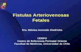 Fistulas Arteriovenosas Fetales - cerpo.cl · Malformaciones Vasculares • Anomalías de la morfogénesis de los vasos • Según vasos involucrados y caracteristicas de flujo –