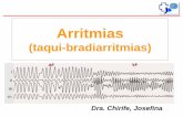 Arritmias - cibic.com.ar fileECG: RS. FC 95lpm, PR160ms, AqRs +30º. Mecanismos de las arritmias Trastornos de la formación del impulso Trastornos de la conducción
