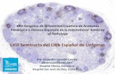 LXIII Seminario del Club Español de Linfomas · Prostatectomía radical Ganglios linfáticos pélvicos... ciclina D1 SOX 11 CD5. 3 yr after dx and tx SOX11 cyclin D1 cyclin D1 SOX11.