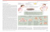tavola 4.93 Malattie e anatomia patologica · In Italia i nuovi casi sono legati a riattivazione ... grado di raggiungere gli alveoli ed eludere la clearance muco-ciliare ... risultati