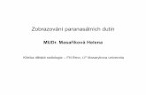 Zobrazování paranasálních dutin - telemedicina.med.muni.cztelemedicina.med.muni.cz/pdm/detska-radiologie/res/... · Sinusitis maxillaris oboustranně - vpravo hladinka tekutiny,