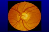 PowerPoint-Präsentation · Ziele der Glaukomchirurgie - Funktionsverfall (GF) stoppen - Regulierung des IOD - Minimierung der Tropftherapie - Vermeidung von Sekundärschäden