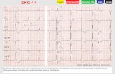 EKG 14 Lösung Vorheriges EKG Nächstes EKG Druck Indexextras.springer.com/2005/978-3-7985-1408-9/EKG 14.pdf · Ventrikel stammende ventrikuläre Extrasystolen (2., 4. und 6. QRS-Komplex