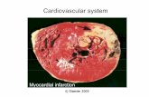 Myocardial infarction - Naresuan Universityภาวะผน งหลอดเล อดแดงแข งต ว (atherosclerosis) • ร ปท 1. เป น histology ของ