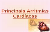 Principais Arritmias Cardíacas 15... · b)Taquicardias ventriculares: Taquicardia ventricular: caracteriza-se por três ou mais extrassístoles seqüenciais, numa freqüência de