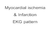 Myocardial ischemia & Infarction EKG pattern · Myocardial ischemia & Infarction EKG pattern Author: pikul Created Date: 5/7/2011 6:52:08 AM ...