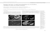 Imagen del mes: Lesión focal hepática en el cirrótico ...gastrolat.org/DOI/PDF/10.0716/gastrolat2019n1000.06.pdf · caracteres de hepatocarcinoma (HCC) multifocal versus mixto.