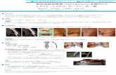 剣状突起切除術（Xiphoidectomy）を施行した レク …katsuura-seikei.or.jp/report/rinspo20121103inada.pdf剣状突起切除術（Xiphoidectomy）を施行した レクリエーショナル・サーファーの一例