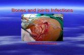 Bones and Joints Infections › acamed › web-ortho › weerachai.pdf · Acute osteomyelitis Blood supplies to the bone reduce and dead bone is developed: If acute stage is unable