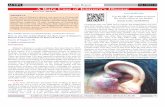 A Rare Case of Kimura's Diseaseacofs.weebly.com/uploads/2/3/6/9/23692028/acofs0011.pdf · 2018-09-09 · bly Kimura disease. Discussion Kimura's disease was first described in China