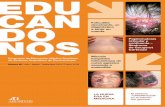 decalvante, un cuenta Papilomatosissd-1617202-h00001.ferozo.net/wp-content/uploads/... · La foliculitis decalvante es un tipo infrecuente de alopecia cicatrizal neutrofílica, de