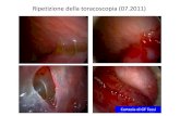 Ripetizione della toracoscopia (07.2011) - ATS Brescia · TC-torace (post-toracoscopia): pneumotorace, ispessimento pleura mediastinica, pleura sovradiaframmatica, pleura - viscerale