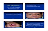 Cleft Lip & Palatespesialis1.bpre.fk.unair.ac.id/wp-content/uploads/...Celah pada bibir (cacat bawaan) disebabkan kegagalan fusi dari prominentia pada masa embrio. Bisa bersama –sama