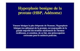 Hyperplasie benigne de la prostate (HBP, Adénome)...prostate (HBP, Adénome) Tumeur bénigne la plus fréquente de l'homme, l'hyperplasie bénigne (ou adénome) de la prostate, est