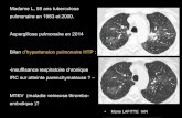 Madame L, 58 ans tuberculose pulmonaire en 1983 et 2000. …onclepaul.net/wp-content/uploads/2011/07/CPC-post-emboli... · 2016. 5. 2. · CAT devant une perfusion en mosaïque Asthme/BPCO