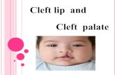 Cleft lip and Cleft palate - Chiangmaihealth.go.th...Cleft lip and cleft palate ค อ เป นความพ การท เก ดร วมก บภาวะผ ดปกต